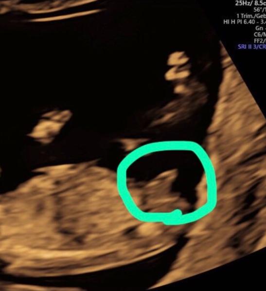 Bild zu Geschlechtsbestimmung - Forum für Januar - Mamis