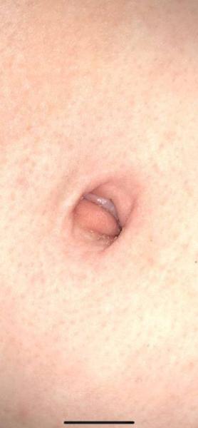 Bild zu Bauchnabelgranulom - Forum für Januar - Mamis