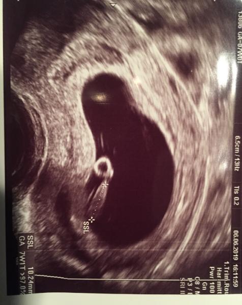 Bild zu 2. Termin und Herzschlag - Forum für Januar - Mamis