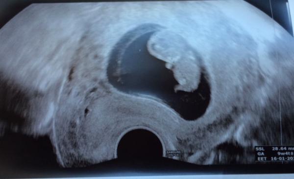 Bild zu FA und neues Ultraschallbild - Forum für Januar - Mamis