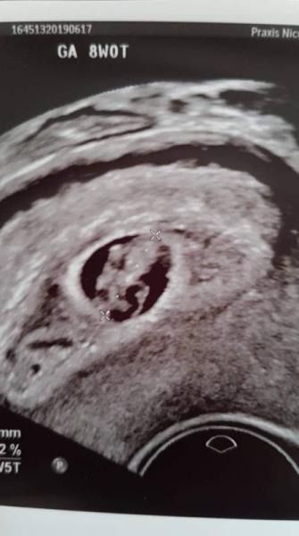 Bild zu 8+0, Embryo OK, FH zu klein, Dottersack zu groß - Forum für Januar - Mamis