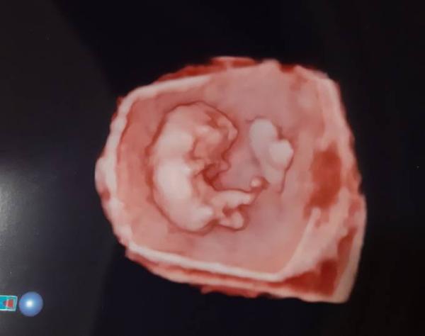 Bild zu 3D Ultraschallbild :) - Forum für Januar - Mamis