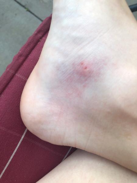 Bild zu Meint ihr das ist entzündet? - Forum für Januar - Mamis