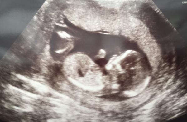 Bild zu Ich durfte auch endlich wieder mein Krümelchen sehen - Forum für Januar - Mamis