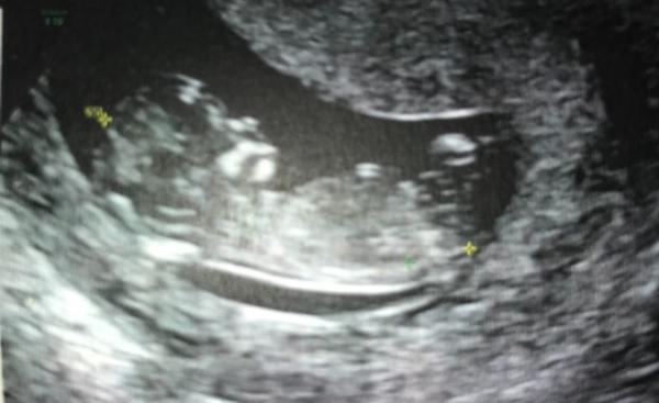 Bild zu 1. Trimester Screening - Forum für Januar - Mamis