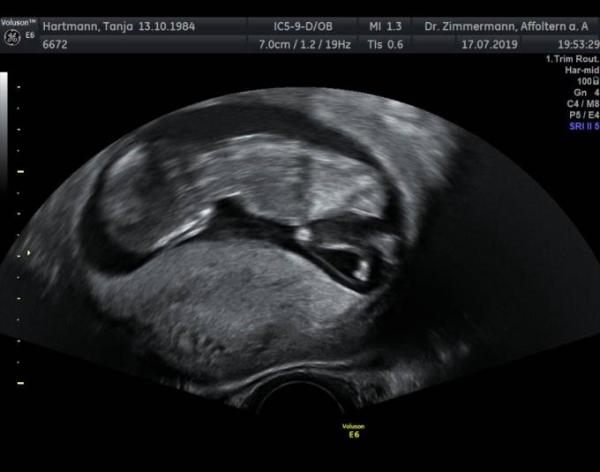 Bild zu Ersttrimesterscreening - Forum für Januar - Mamis