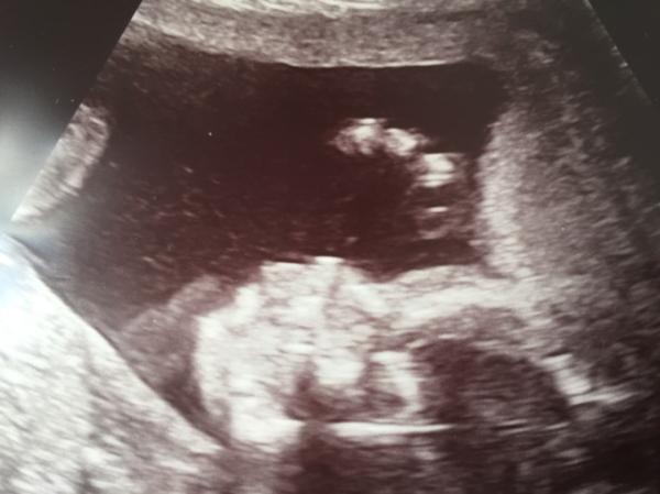 Bild zu Feindiagnostik geschafft - Forum für Januar - Mamis