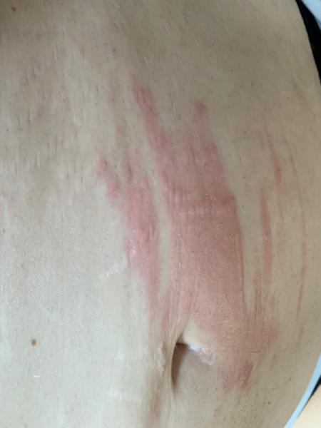 Bild zu Verbrannt .... - Forum für Januar - Mamis