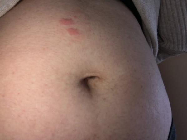 Bild zu jucken auf dem bauch mit flecken - Forum für Januar - Mamis