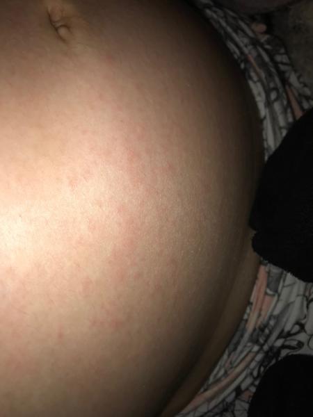 Bild zu Ausschlag auf Babybauch ...? - Forum für Januar - Mamis