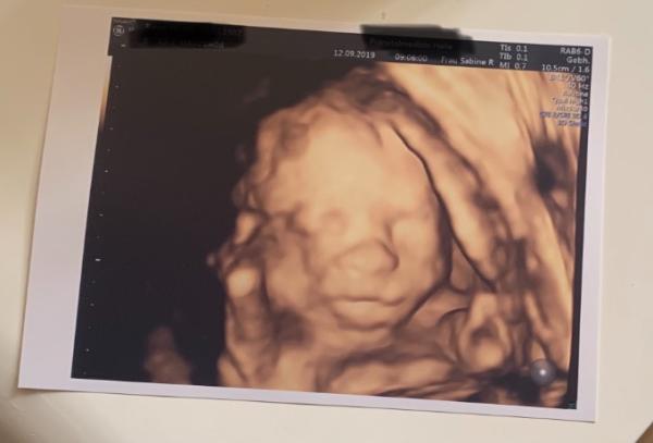 Bild zu Feindiagnostik mit Befund 😬 - Forum für Januar - Mamis