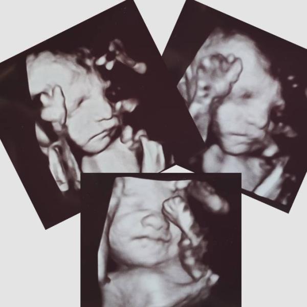 Bild zu Großer Ultraschall und Akupunktur 🥰 - Forum für Januar - Mamis