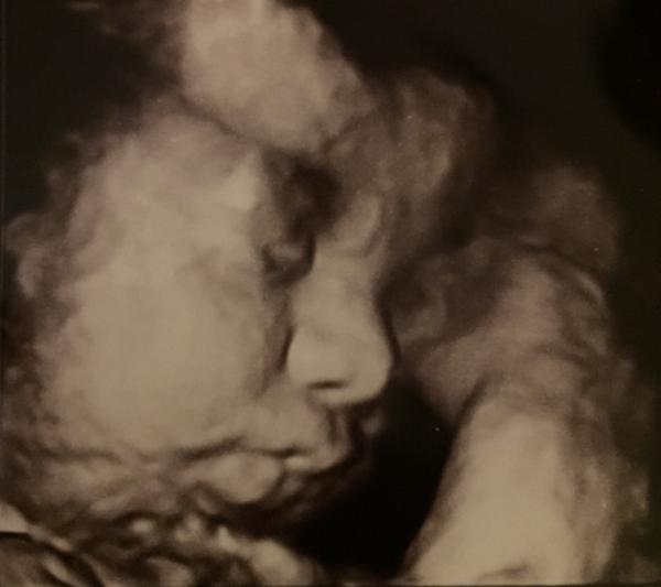 Bild zu Zurück vom Arzt...Mopsbacken-Alarm 🙈 - Forum für Januar - Mamis