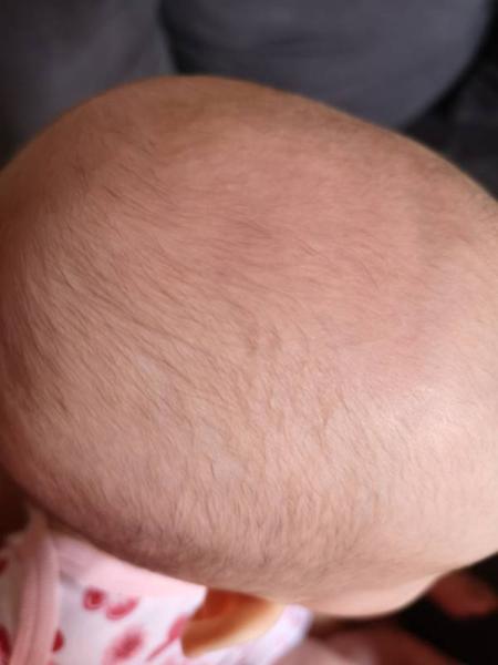 Bild zu Noch jemand ohne Haare? - Forum für Januar - Mamis