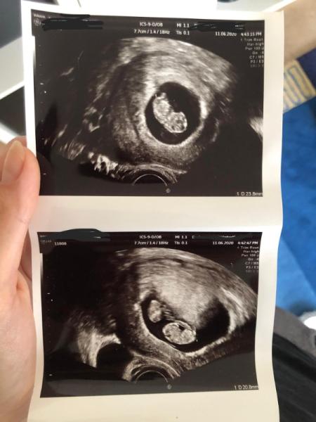 Bild zu Zwillingsschwangerschaft / Zwillinge von früherer ss? - Forum für Januar - Mamis