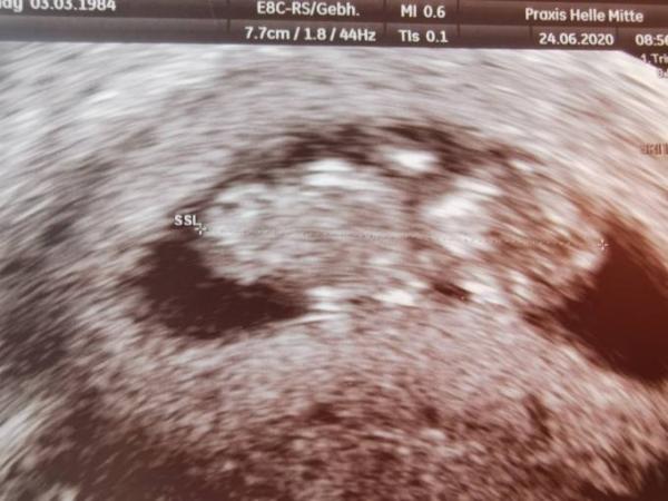 Bild zu Ultraschal - Forum für Januar - Mamis