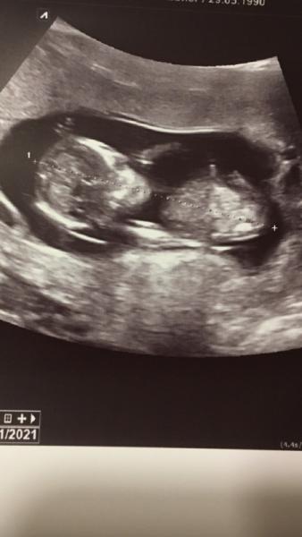 Bild zu Zurück vom Ersttrimester-Screening/Nackenfaltenmessung - Forum für Januar - Mamis
