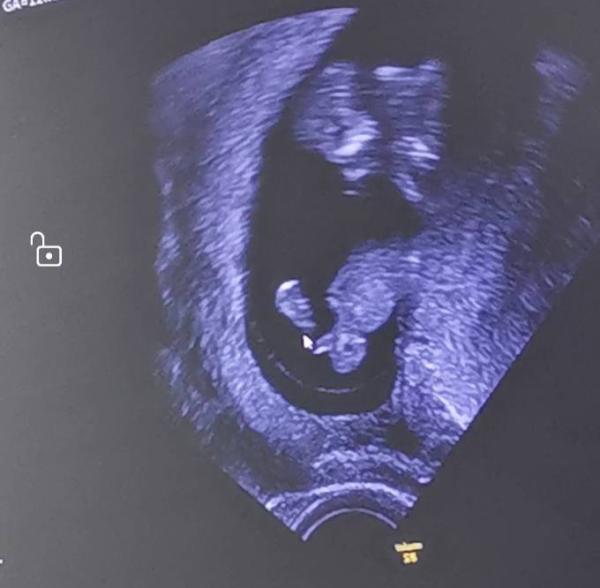 Bild zu Is das der nub? Fals ja nach was sieht es aus? - Forum für Januar - Mamis