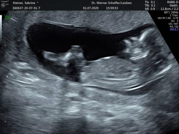 Bild zu Ersttrimester Screening - Forum für Januar - Mamis