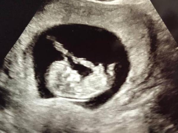 Bild zu Ultraschall und dann doch Harmony Test - Forum für Januar - Mamis