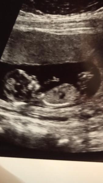 Bild zu Nackenfaltenmessung unauffällig - Forum für Januar - Mamis