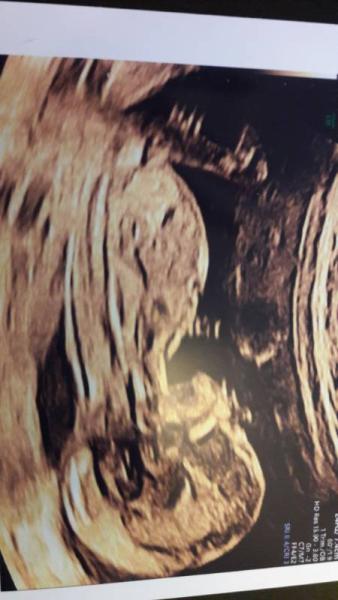 Bild zu Nackenfaltenmessung überstanden - Forum für Januar - Mamis