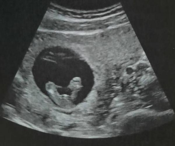 Bild zu Tendenz bekommen... Was meint ihr? - Forum für Januar - Mamis