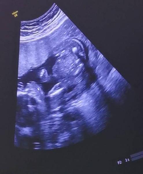 Bild zu ZurĂĽck vom 2 ten grossen Ultraschall đź’– - Forum fĂĽr Januar - Mamis