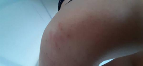 Bild zu Nun ich mal mimimi Gürtelrose - Forum für Januar - Mamis