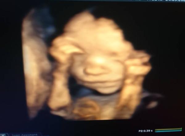 Bild zu Plazenta praevia lateralis - Forum für Januar - Mamis