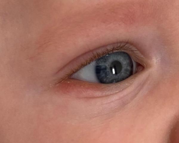 Bild zu Auge Rot - Forum für Januar - Mamis