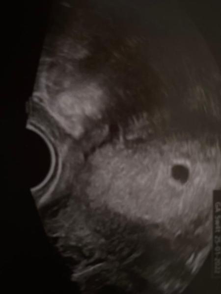 Bild zu Fruchthöhle und evtl dottersack? - Forum für Januar - Mamis