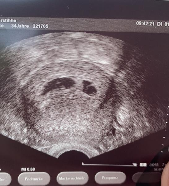 Bild zu 1.Ultraschall - Forum für Januar - Mamis