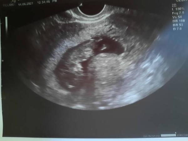 Bild zu 1. Mal Herzschlag und konkreter Entbindungstermin - Forum für Januar - Mamis