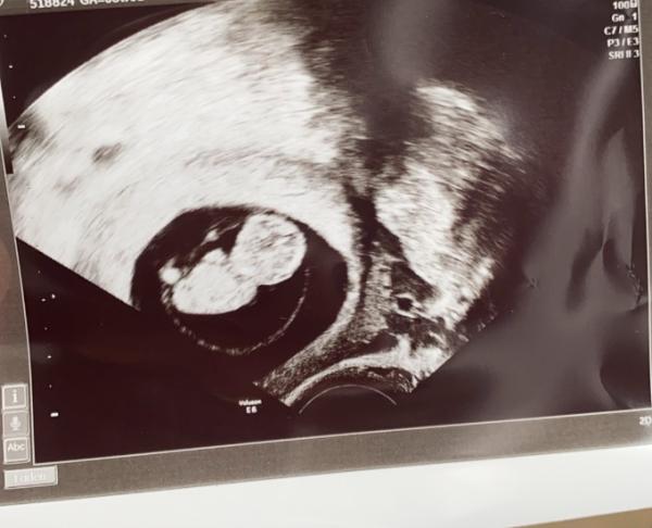 Bild zu Angst vor erneuter Fehlgeburt - Forum für Januar - Mamis