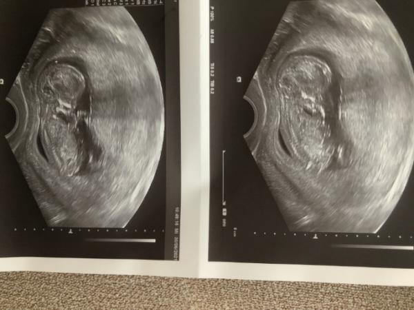 Bild zu Endlich 12. Woche! - Forum für Januar - Mamis