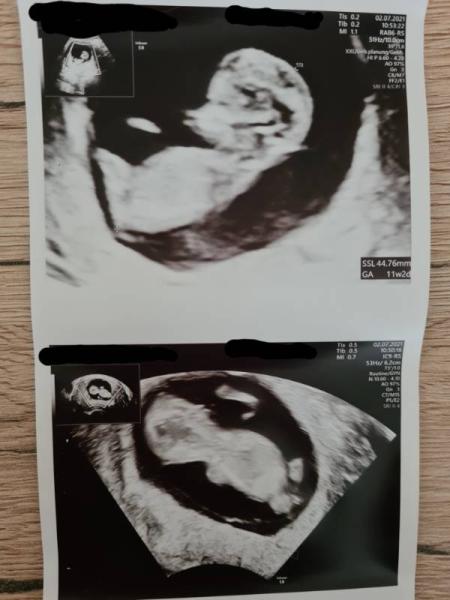 Bild zu Beginn 12 SSW - 2. Ulltraschall alles prima - Forum für Januar - Mamis