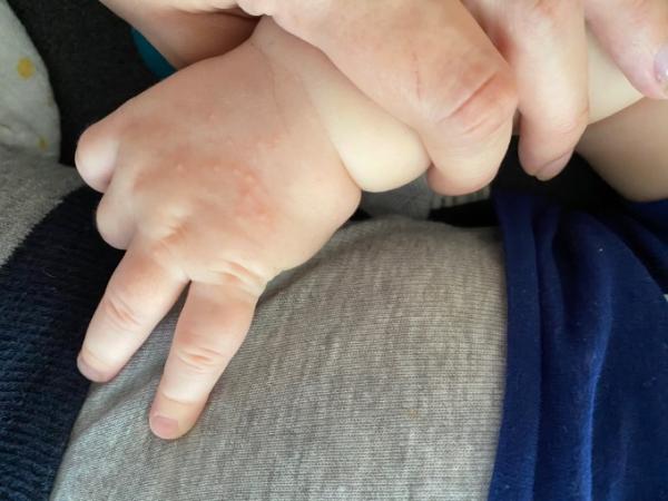 Bild zu Pickelchen - Forum für Januar - Mamis