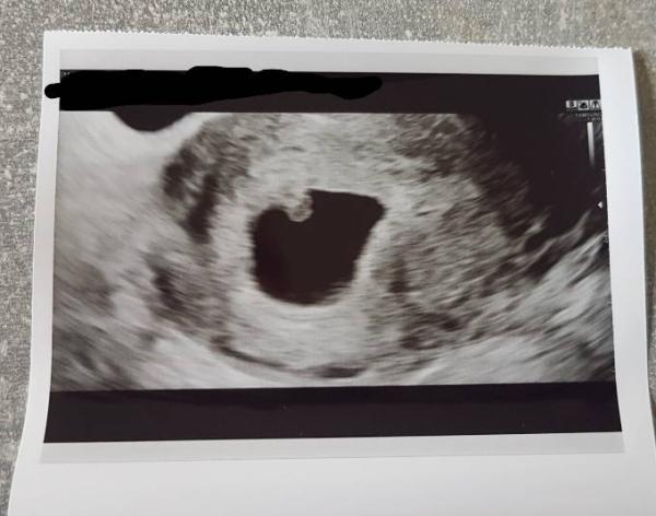 Bild zu Endlich das erste Ultraschallbild ❤ - Forum für Januar - Mamis