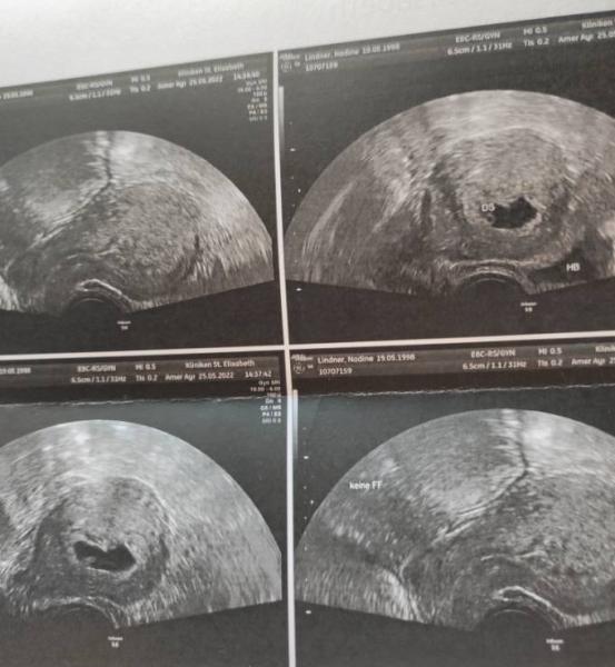 Bild zu 8+0 nur Fruchthöhle & Dottersack - Forum für Januar - Mamis