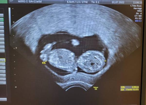 Bild zu Ultraschall 12ssw - Forum für Januar - Mamis