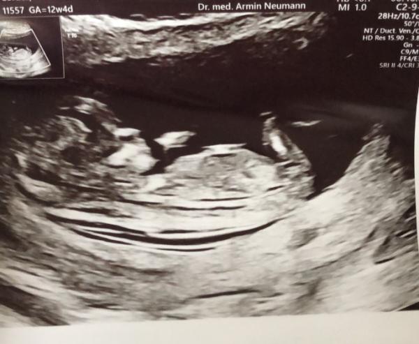Bild zu ETS positiv verlaufen :) wir freuen uns! - Forum für Januar - Mamis