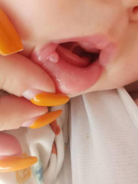 Bild zu Blase im Mund und keiner weiß was - Forum für Januar - Mamis