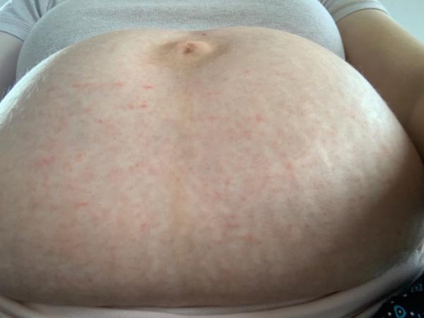 Bild zu Kleine rote Pickelchen? - Forum für Januar - Mamis