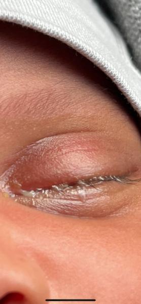 Bild zu Verklebtes Auge - Forum für Januar - Mamis