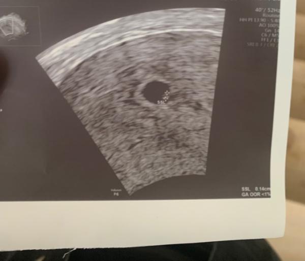 Bild zu US 5+5, niedriger Progesteronwert - Forum für Januar - Mamis