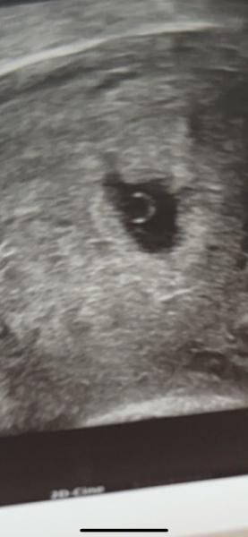 Bild zu Kein embryo zu sehen 😣 - Forum für Januar - Mamis