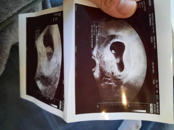 Bild zu Dottersack sieht komisch aus.. - Forum für Januar - Mamis