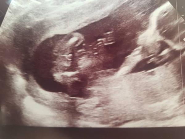 Bild zu Geschlecht 18ssw erkennen - Forum für Januar - Mamis