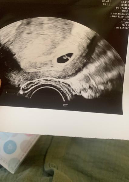 Bild zu Ultraschall in 5+5 - Forum für Januar - Mamis